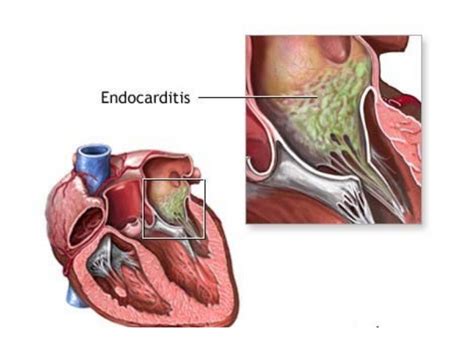 Endocarditis