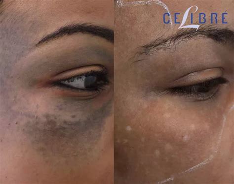 Nevus Of Ota Birthmark Laser Removal