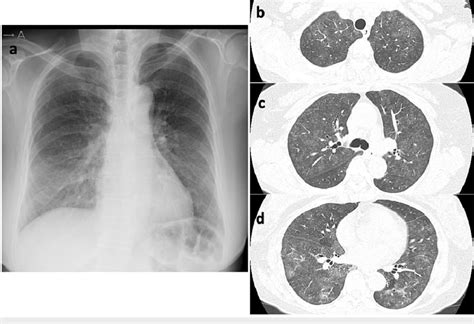 Chest X Ray And Chest CT Images Of The Patient A Ground Glass