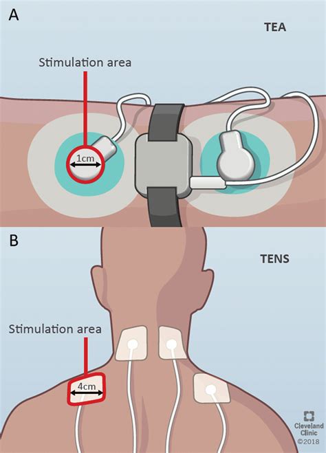 Key Differences Of Transcutaneous Electroacupuncture And Transcutaneous