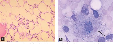 Figure 1 From A Case Of Hemophagocytic Syndrome In A Patient With