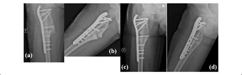 Immediate Postop Ap A And Lateral B Radiographs Final Follow Up Ap