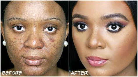 HOW TO COVER ACNE DARKSPOTS HYPERPIGMENTATION MY ACNE COVERAGE