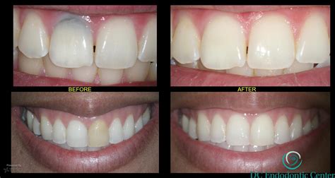 Intracoronal Bleaching - DC Endodontic Center