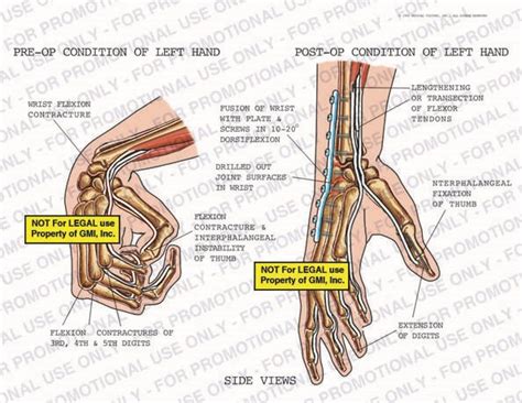 Pre Op Vs Post Op Conditions Of The Left Hand 99288b50a Generic Medical Legal Exhibits A