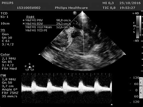 Transcranial Doppler Image The Indicates The Peak Systolic Download Scientific Diagram