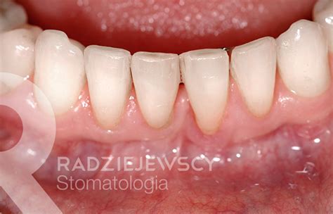 Metamorfozy Stomatologia Radziejewscy Ortodoncja I Nak Adki Invisalign