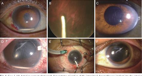 Figure 1 From Management Of Anterior Chamber Migration Of Dexamethasone Intravitreal Implant