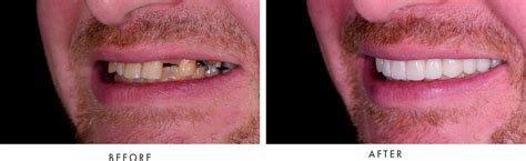 Before & After Photos | Advanced Smile Dentistry | Toms River, NJ