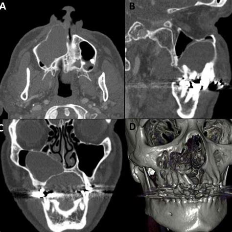 Ct Scan That Showed Hypodense Lesion In Right Maxillary Sinus With