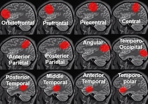 Middle Cerebral Artery Stroke