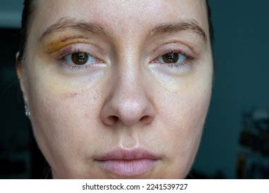 Woman Face Recovery After Plastic Surgery Stock Photo 2241539727 ...