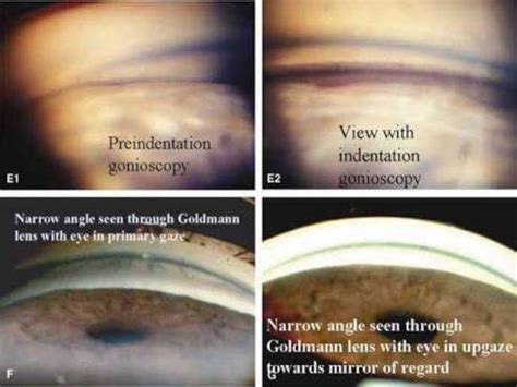 Gonioscopy Gonioscopic Lenses Principle And Clinical Aspects