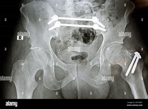 Fractura Del Muslo Fotografías E Imágenes De Alta Resolución Alamy