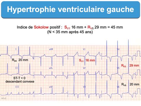 Hypertrophie Vg Hvg 1 Diagnostic E Cardiogram