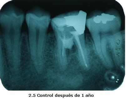 Reparaci N De Perforaci N De Furca Utilizando Agregado De Tri Xido