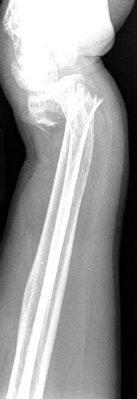 Anteroposterior A And Lateral B Plain Radiographs Of The Fracture