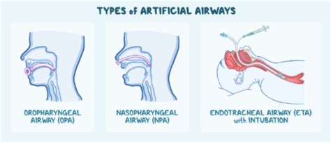 Understanding Airway Management Devices And How They Differ Molded