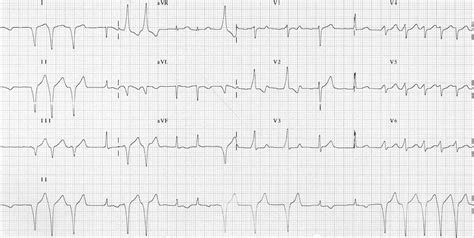 Pre Excitation Syndromes • Litfl • Ecg Library Diagnosis