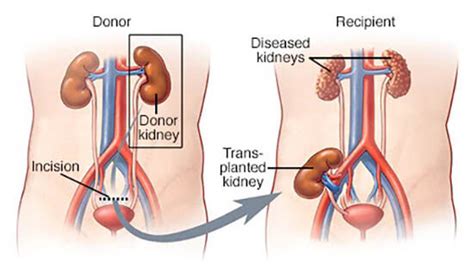 Recovery after kidney transplant | Recovery period at home