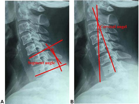 Figure 1 From Comparison Of Percutaneous Endoscopic Cervical Keyhole