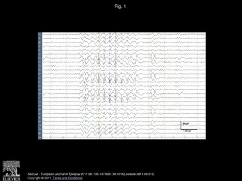 Seizure Freedom With Vns Monotherapy A Case Report Ppt Download