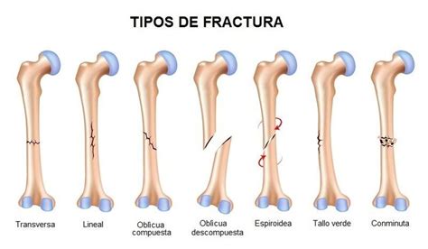 Desplazada No Desplazada Fractura Conminuta Espiral Transversal