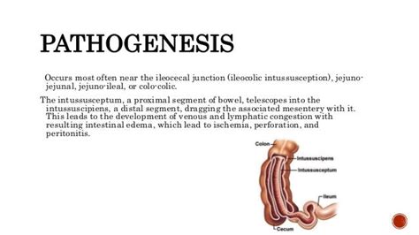 Intussusception