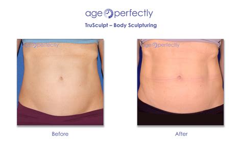 Trusculpt Body Sculpturing Age Perfectly