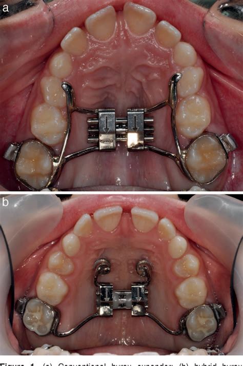 Figure 1 From Pain And Discomfort During The First Week Of Rapid