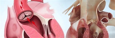 Aortic Stenosis Anatomy Diagnosis Treatment - The Valve Clinic