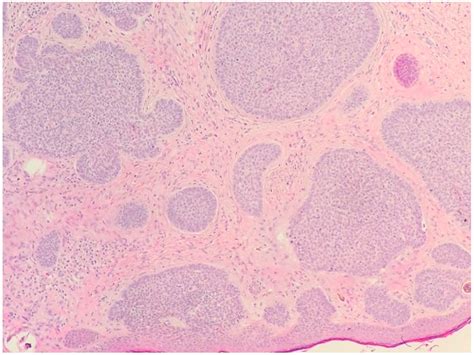 Morpheaform Basal Cell Carcinoma Histology