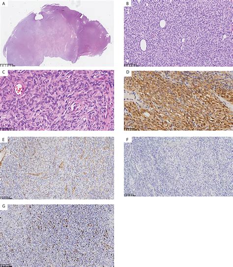 Frontiers Case Report Identification Of A Novel Heterozygous