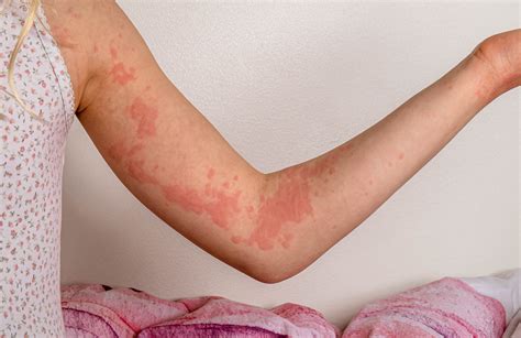 Hives Vs Rash What S The Difference Between Them