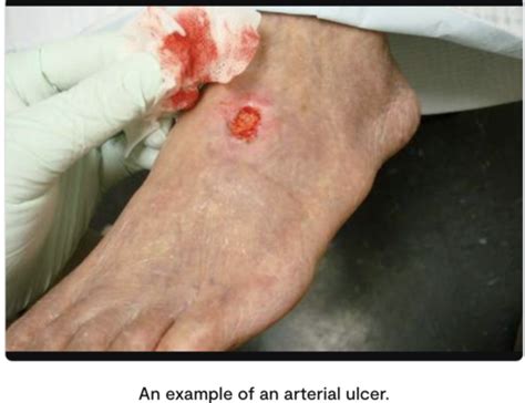 Cardiovascular Arterial Ulcers Flashcards Quizlet Hot Sex Picture