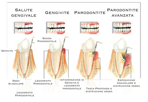 Studiodentisticozemella Parodontologia Malattie Gengivali