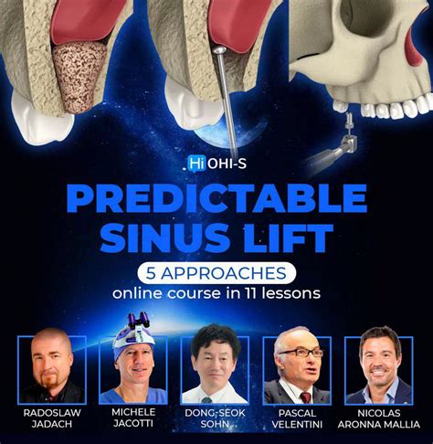 Predictable Sinus Lift Course Dental Courses