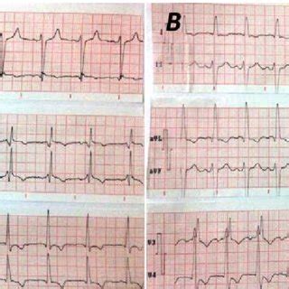 Twelve Lead Electrocardiogram Showing A Precordial Masquerading