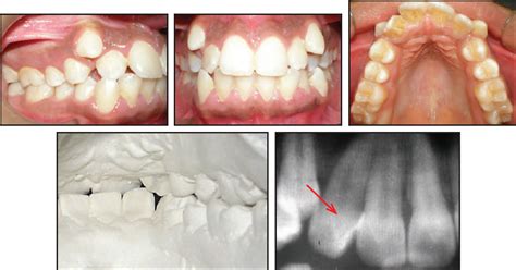 Gradual Grinding of a Talon Cusp During Orthodontic Treatment - JCO ...