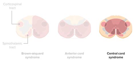 Incomplete Cord Syndromes — Pathophysiology And Treatment Lecturio