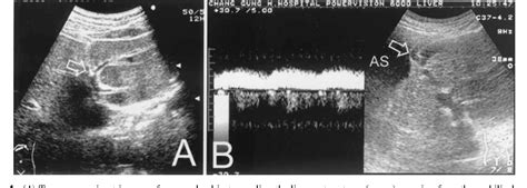 Figure 1 From Comparison Of Prevalence For Paraumbilical Vein Patency In Patients With Viral And