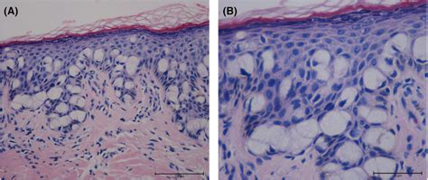 Tissue Section Image Of Primary Pagets Disease Of The Labia