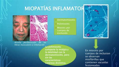 Distrofia Distonia Y Miopatias Musculares PPT