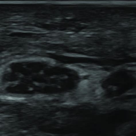 Axial Ultrasonographic Image Of A Swollen Bifid Median Nerve Inside The