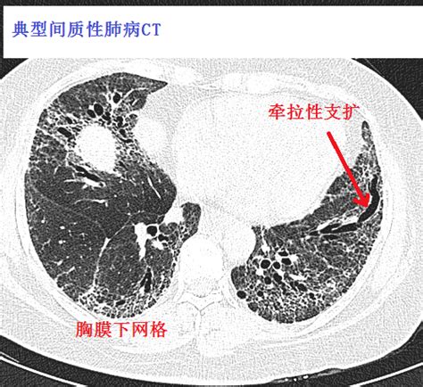 皮肌炎继发的间质性肺炎极易漏诊！从ct上怎么看？患者医生胸膜