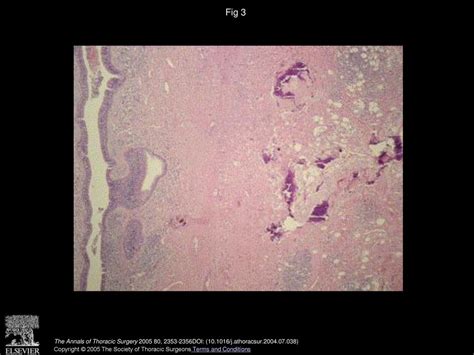 A Giant Endobronchial Inflammatory Polyp Ppt Download