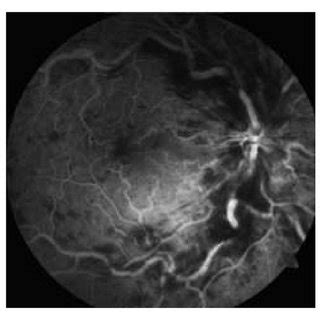 A Fundus Photograph Of The Left Eye Shows Central Retinal Vein