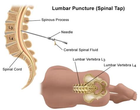 Lumbar Puncture Iliac Crest