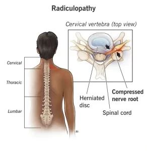 Lumbar-Radiculopathy - Acu-hump Sciatica Relief