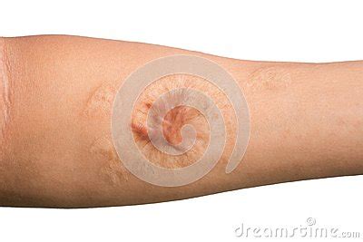 Close Up Keloid Scar Hypertrophic Scar On Man Arm Skin After A Royalty